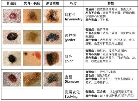 乳頭長痣|痣是什麼？會變成黑色素瘤？7種一定要除的痣